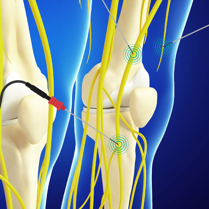 genicular nerve ablation in Coppell