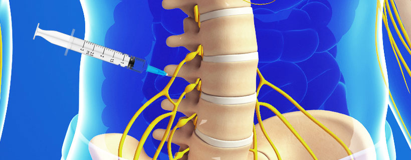 patient receiving Lumbar Transforaminal Epidural Steroid Injections in Coppell for auto accident injury pain relief