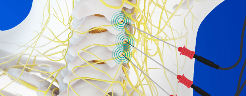 patient receiving Radiofrequency Neurotomy in Coppell for auto accident injury pain relief
