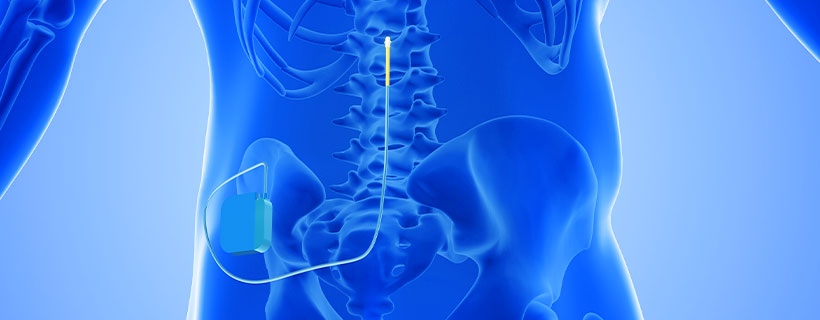 patient receiving Spinal Cord Stimulator Implant in Coppell for auto accident injury pain relief