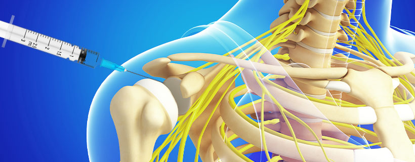 patient receiving Subacromial Injections in Coppell for auto accident injury pain relief