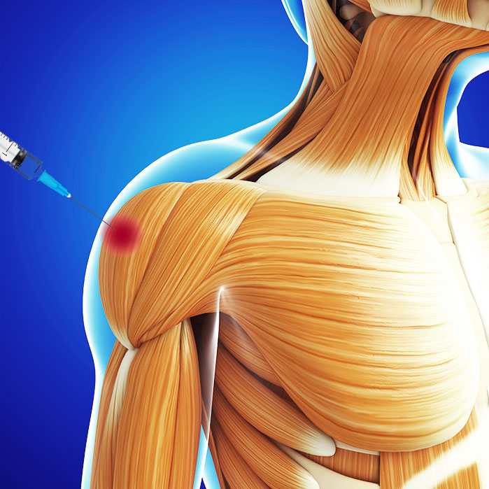 trigger point injections in Coppell